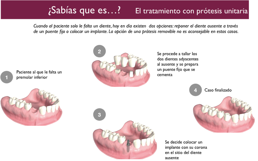 Cual es el mejor fijador para protesis dentales